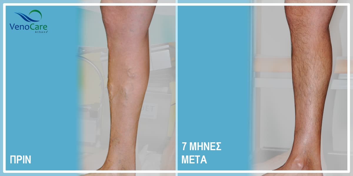 Πριν και μετά κιρσοί